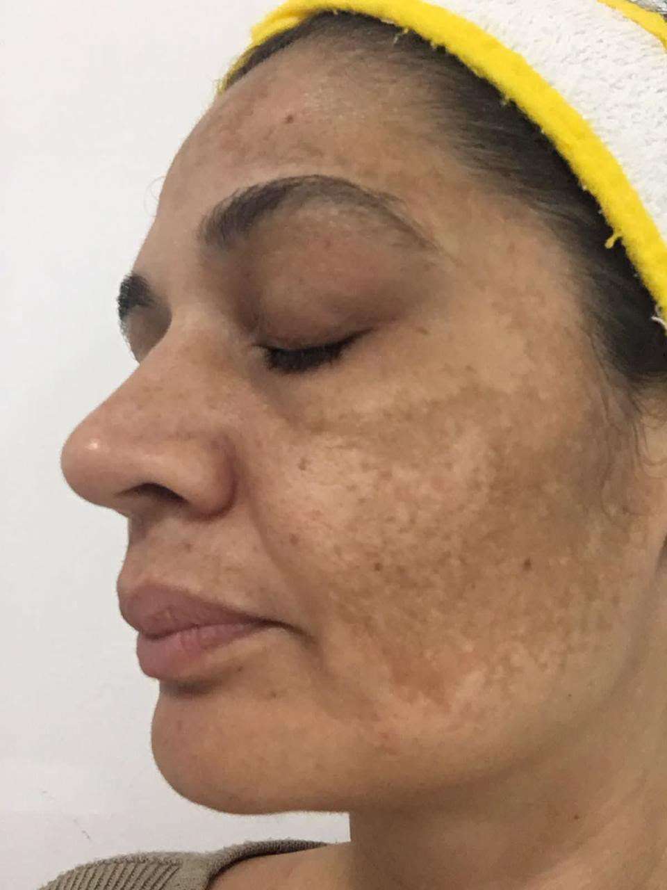 Registro real de pele em acompanhamento no Nivalda Centro de Estética