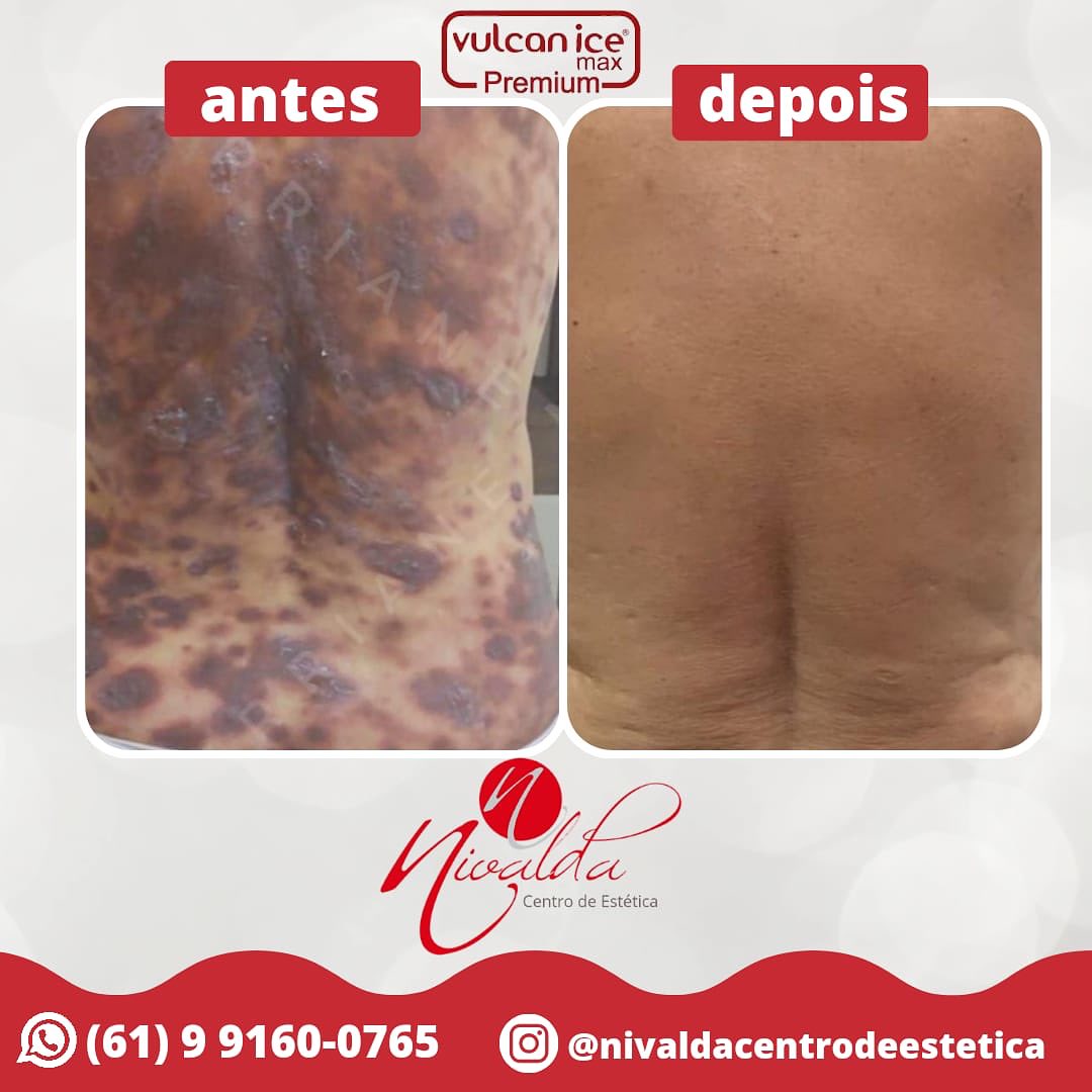 Comparação de antes e depois de atendimento estético