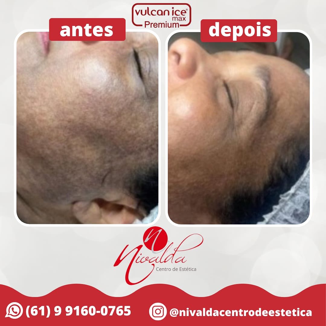 Registro de resultado de tratamento estético realizado no Nivalda Centro de Estética